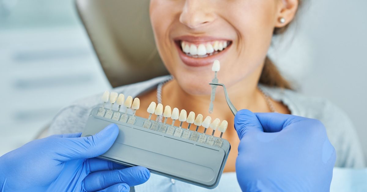 Veneers color chart being matched to a patient's tooth shade