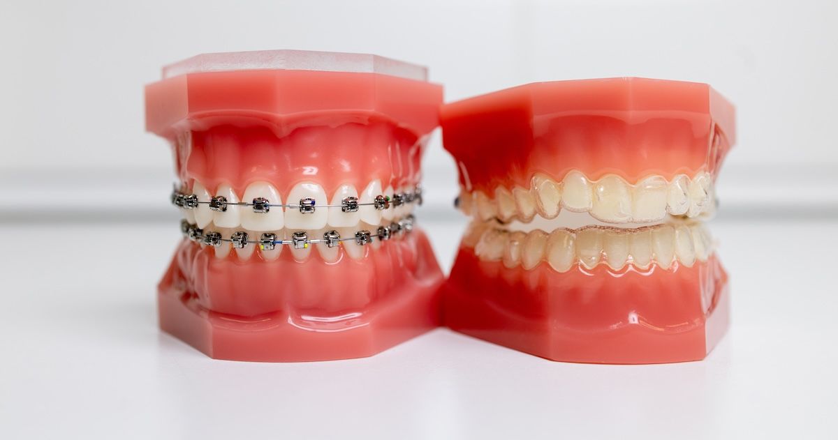 Twee neptandprotheses: één met een slotjesbeugel en één met aligners.
