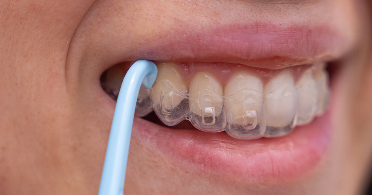 Aligner verwijderen met een outie
