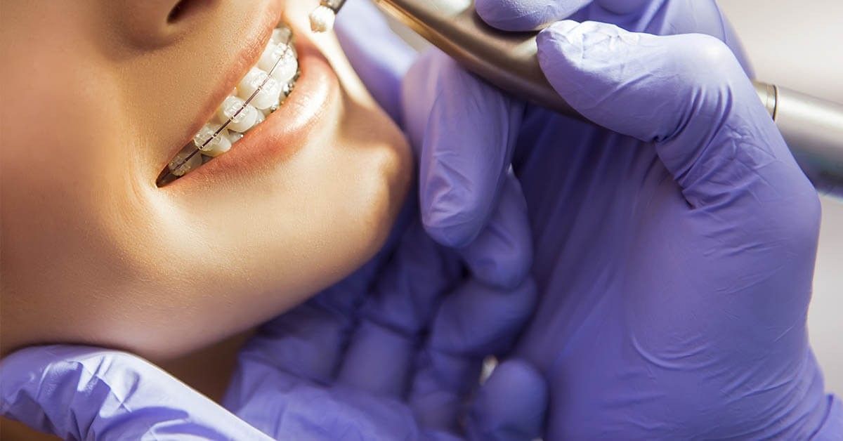 Brackets cerámicos ventajas, precios y alternativas 🦷