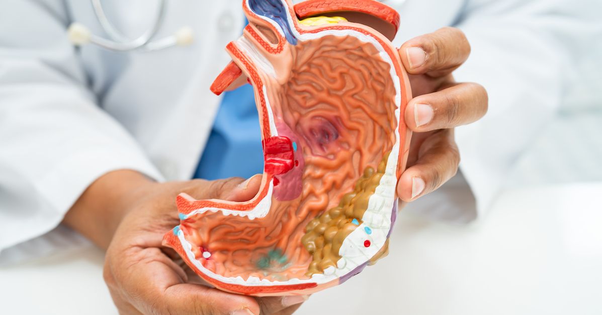 Las manos de un doctor sujetan la maqueta de un estómago.