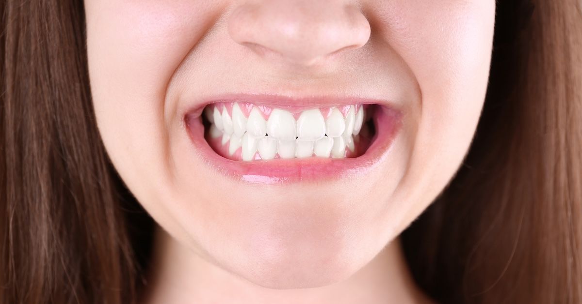 Een mond die aan het tandenknarsen is