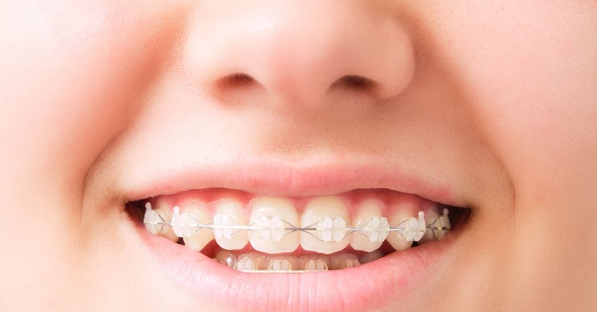 Woman with clear braces