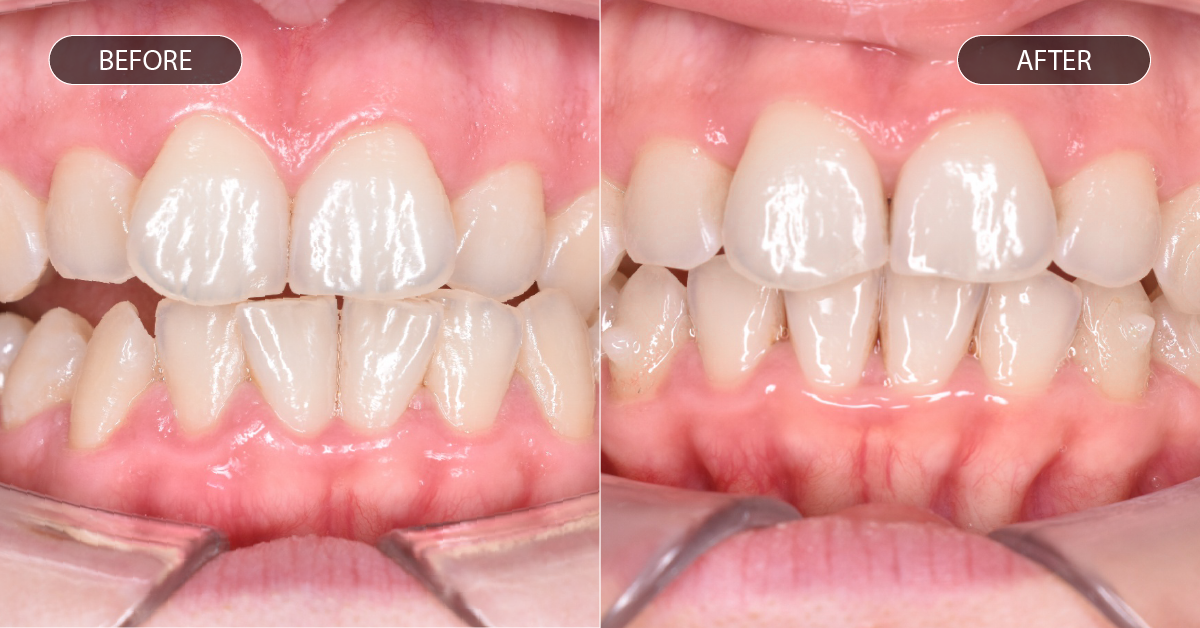 voor en na foto van kruistbeet met aligners