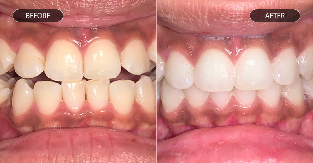 Voor en na foto van open beet met aligners