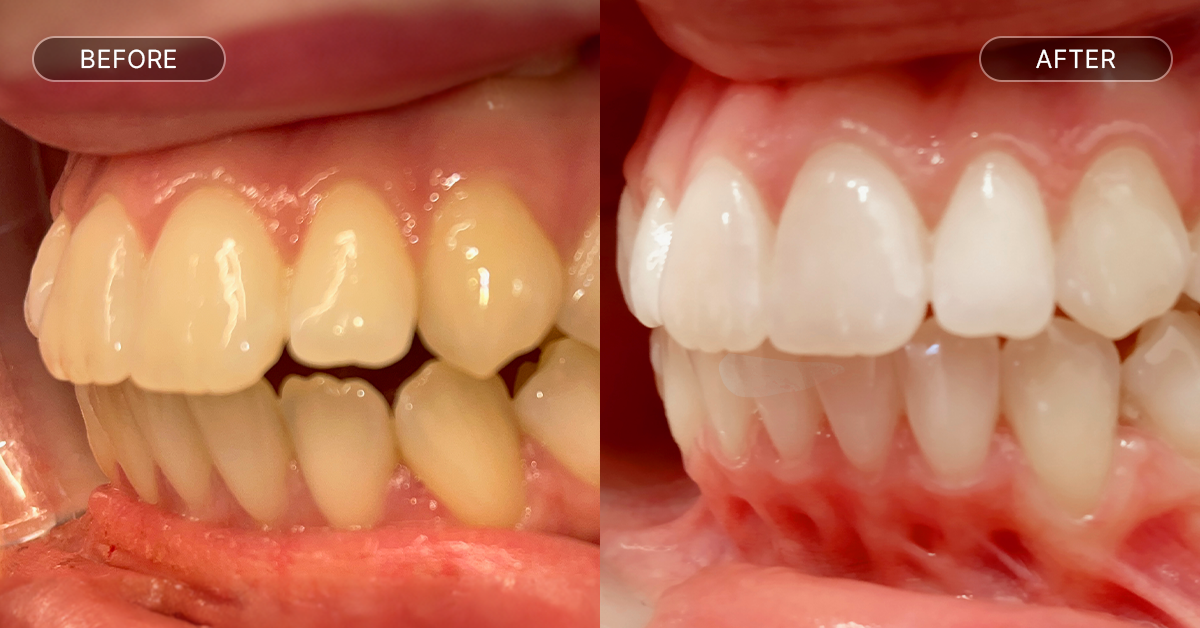 voor en na foto van overbeet met aligners