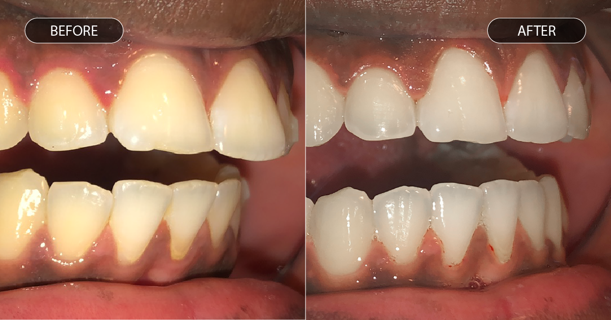 Voor en na foto van overjet met aligners