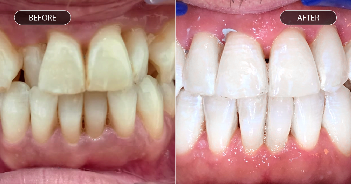 voor een na foto bij scheve tanden met aligners