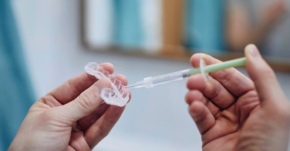 Patiënt die carbamideperoxide aanbrengt in een tandbleekbitje voor een tandenbleekbehandeling thuis.