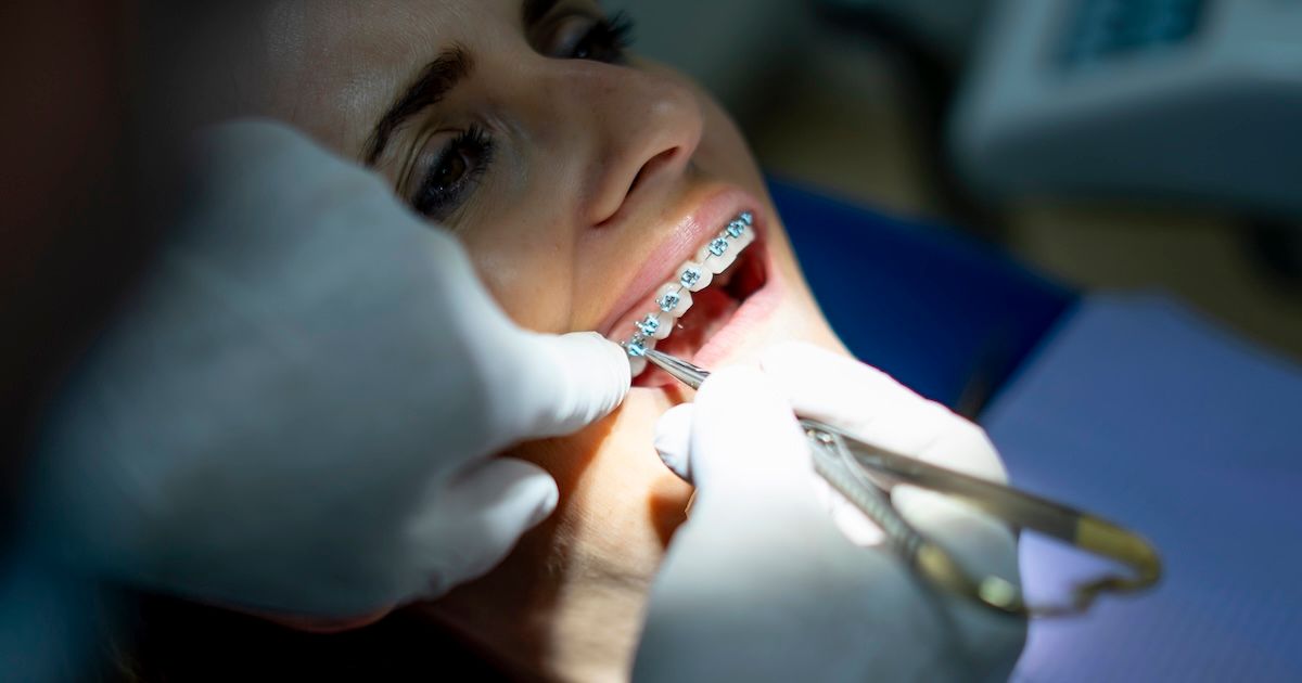Orthodontist die de beugel van een patiënt plaatst