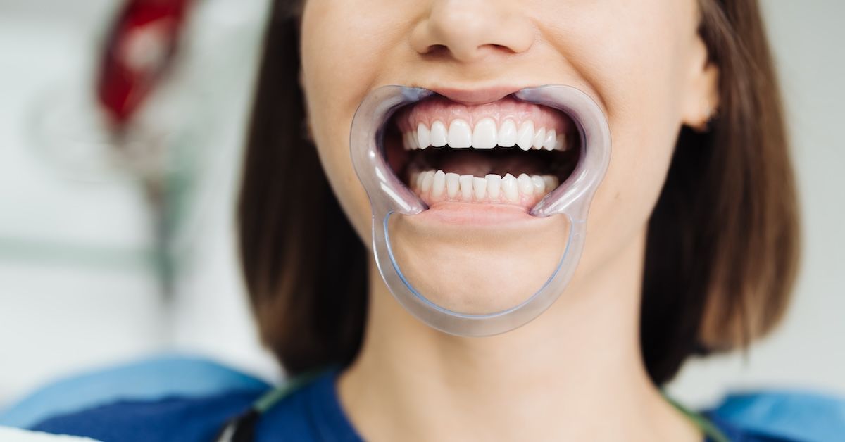 Female patient with a cheek protractor in place