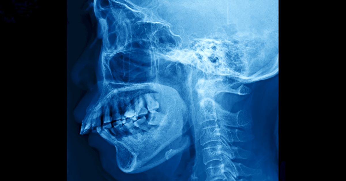 Une radiographie montrant clairement un encombrement dentaire.