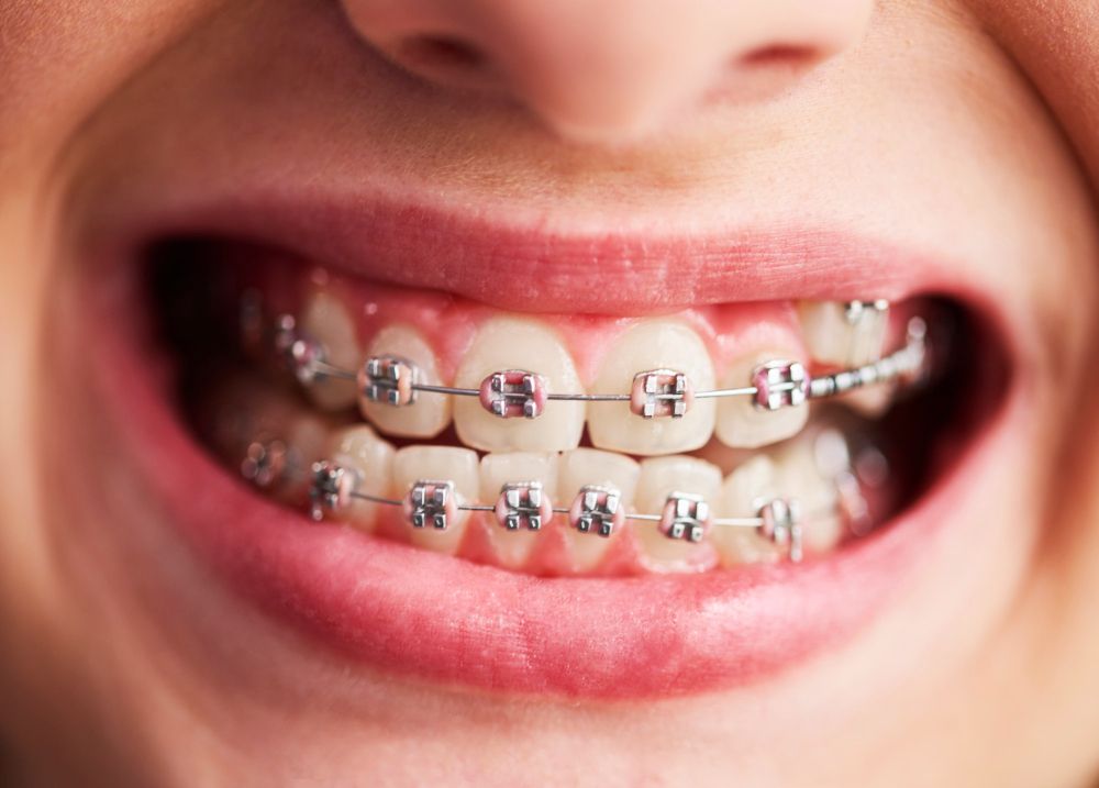 feste Zahnspange mit rosafarbenen Brackets