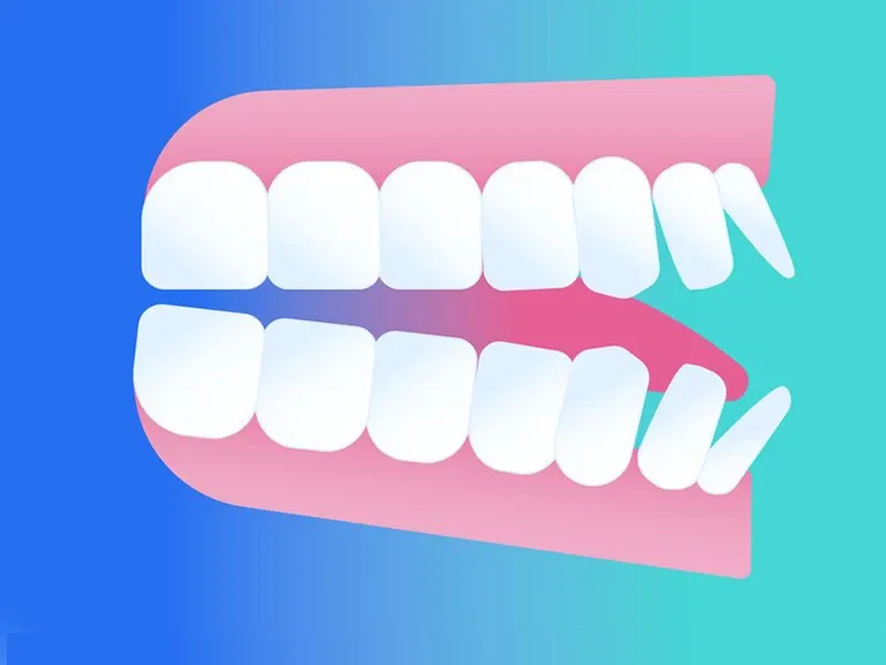 Darstellung des Ober- und Unterkiefers mit verschobenen Frontzähnen